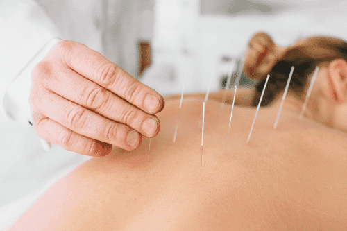 Detox Symptoms After Acupuncture: What to Expect and How to Manage Them